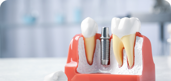 wackerbeck-mueller-leistungen-implantologie-teaser