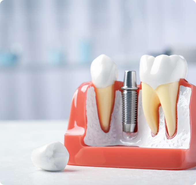 wackerbeck-mueller-leistungen-implantologie