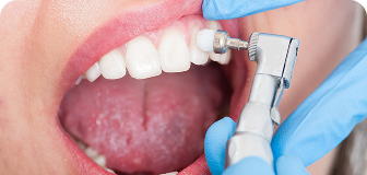 wackerbeck-mueller-leistungen-prophylaxe-teaser